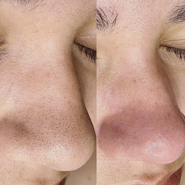 rezultate hidradermabraziune