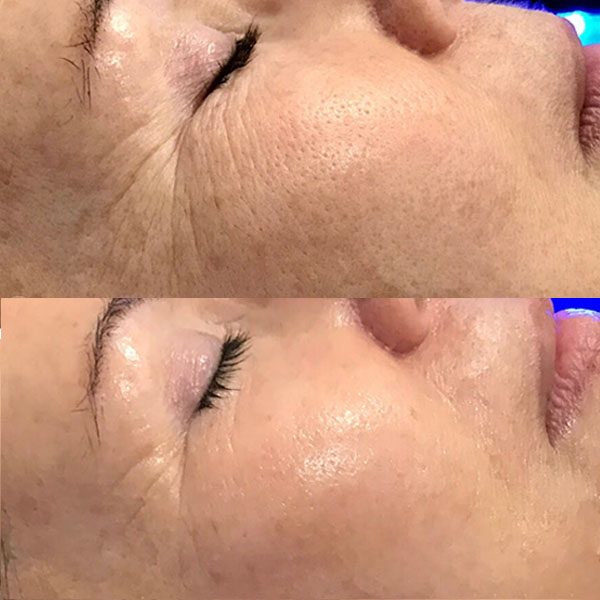 rezultate hidradermabraziune