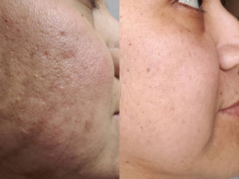 Microneedling elimina cicatricile