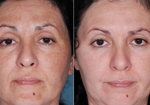 rezultate hidradermabraziune