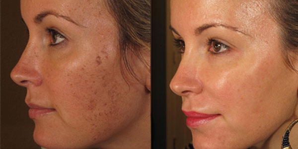 rezultate hidradermabraziune