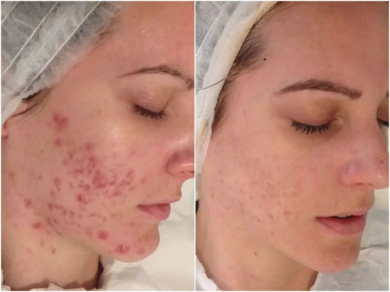 Microneedling elimina cicatricile