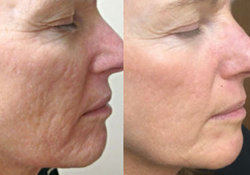 rezultate hidradermabraziune