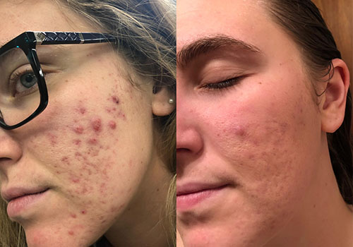 Microneedling elimina cicatricile