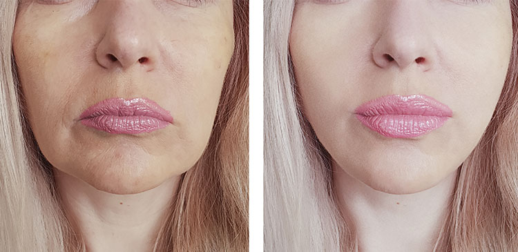 reduce barbia dubla sau gusa