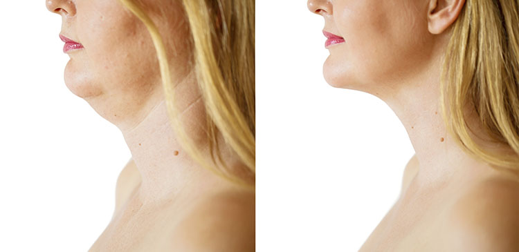 fara barbie dubla sau gusa