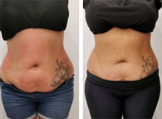 remodelare corporala