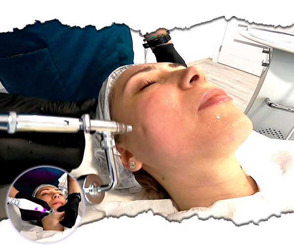 microneedling rejuvenare faciala