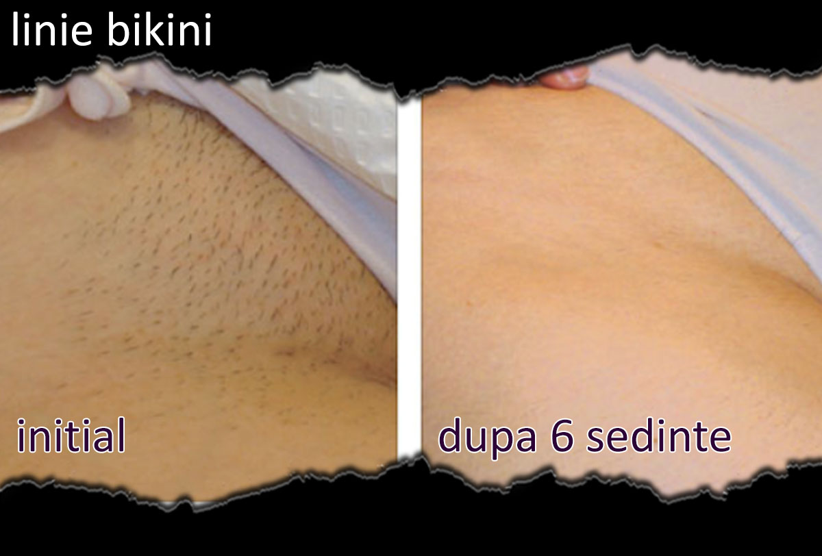 rezultate epilare laser