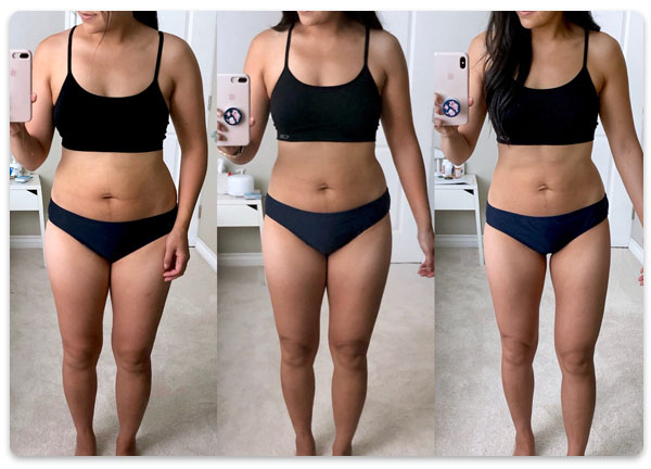 sparge celulite de grasime fibrozate