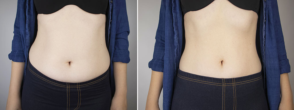 remodelare corporala