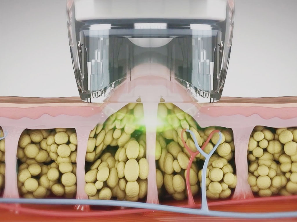 tratament pentru celulita