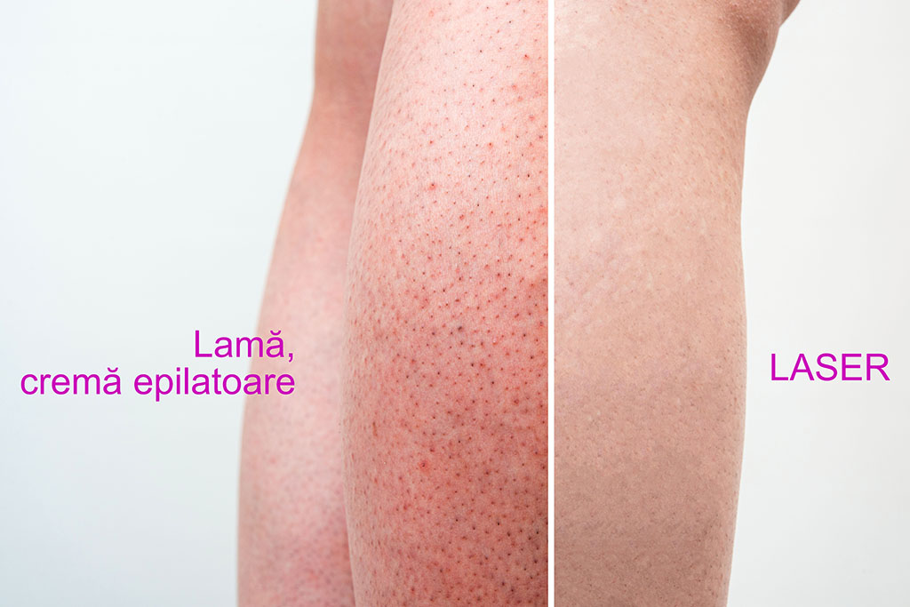 epilare permanenta cu laser