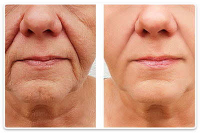 tratamente lifting facial