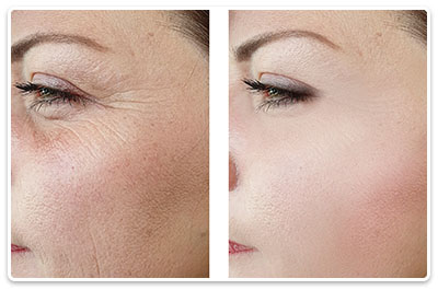 elimina ridurile de pe fata si gat