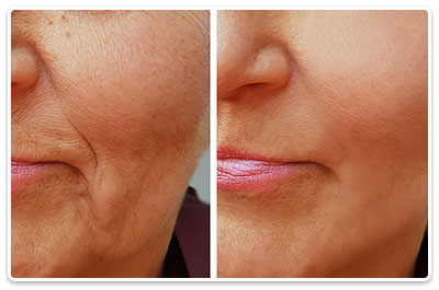 anti-aging si anti-rid