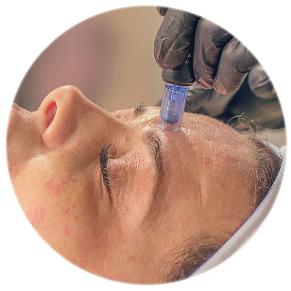 Microneedling elimina cicatricile