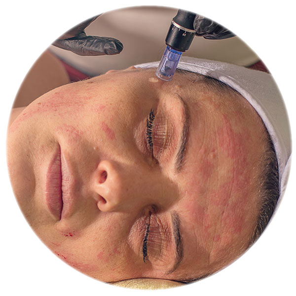 Microneedling elimina cicatricile