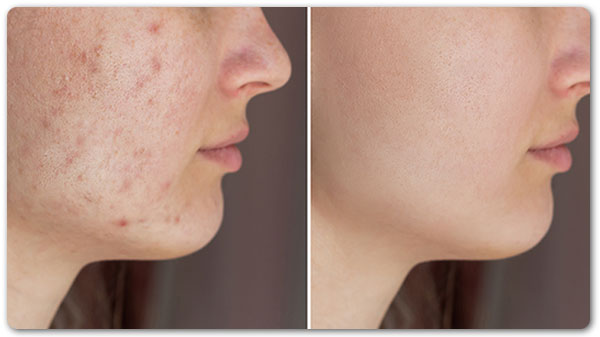 Microneedling elimina cicatricile