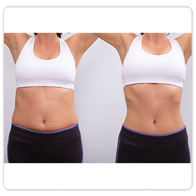 remodelare corporala