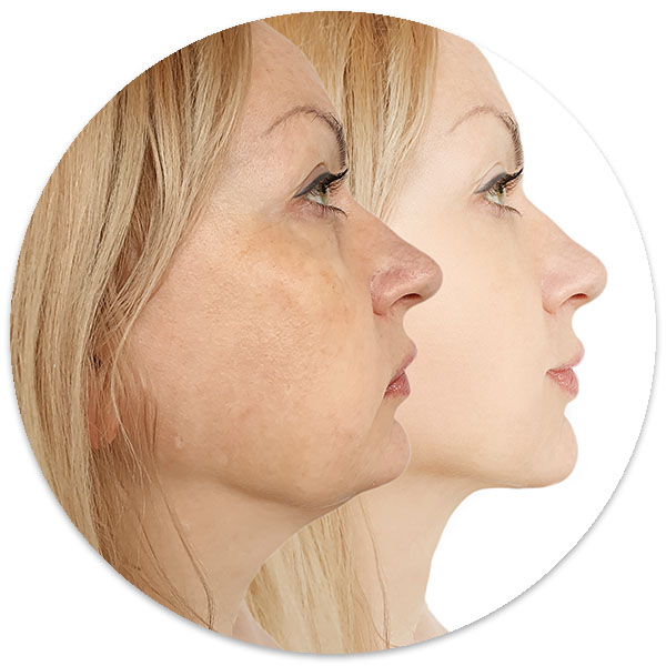 bărbie dubla sau guşă