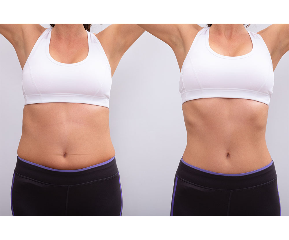 combate celulita pana la grad 4