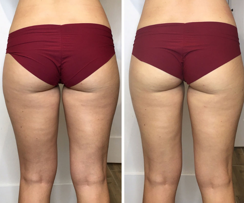 remodelare corporala