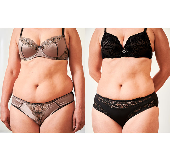 remodelare corporala