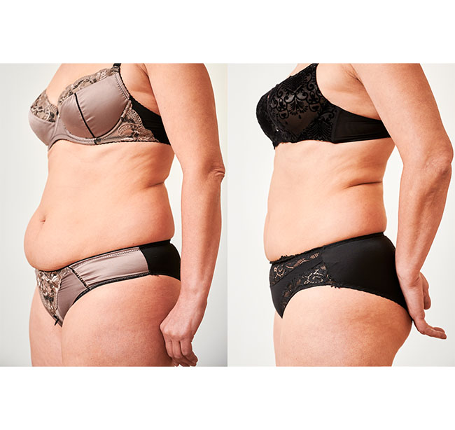 remodelare corporala