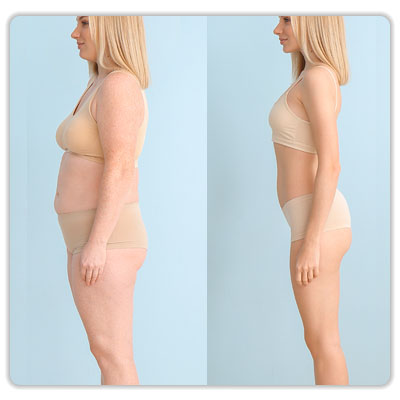 remodelare corporala