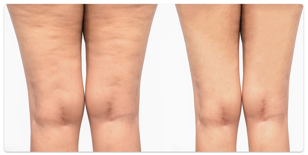 remodelare corporala