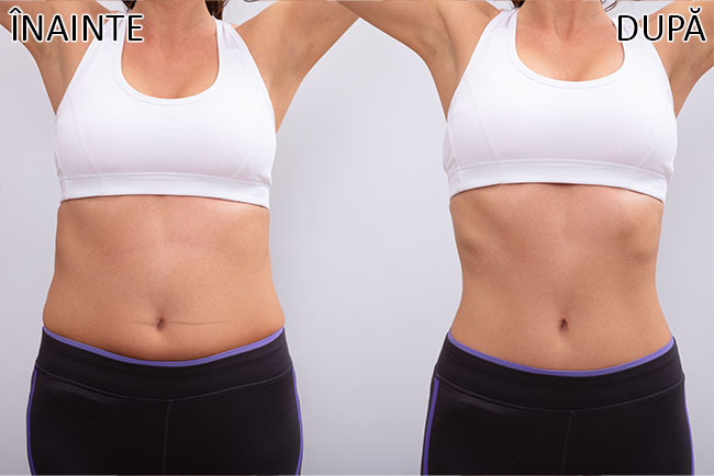 slabire si tonifiere cu EMSlim 