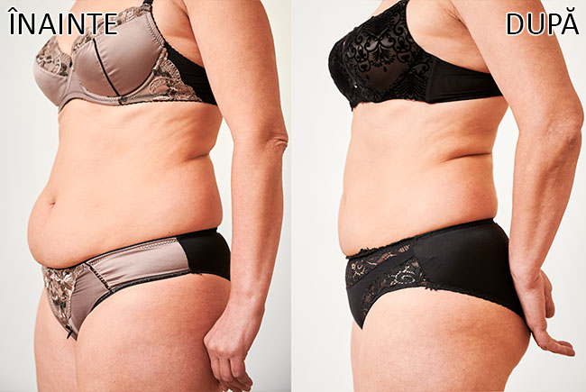 slabire si tonifiere cu EMSlim 