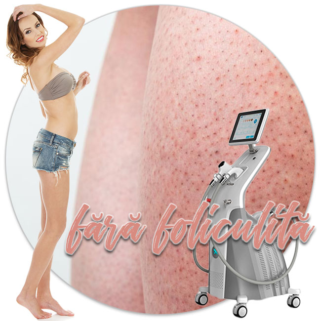 epilare definitiva cu laser in Iasi