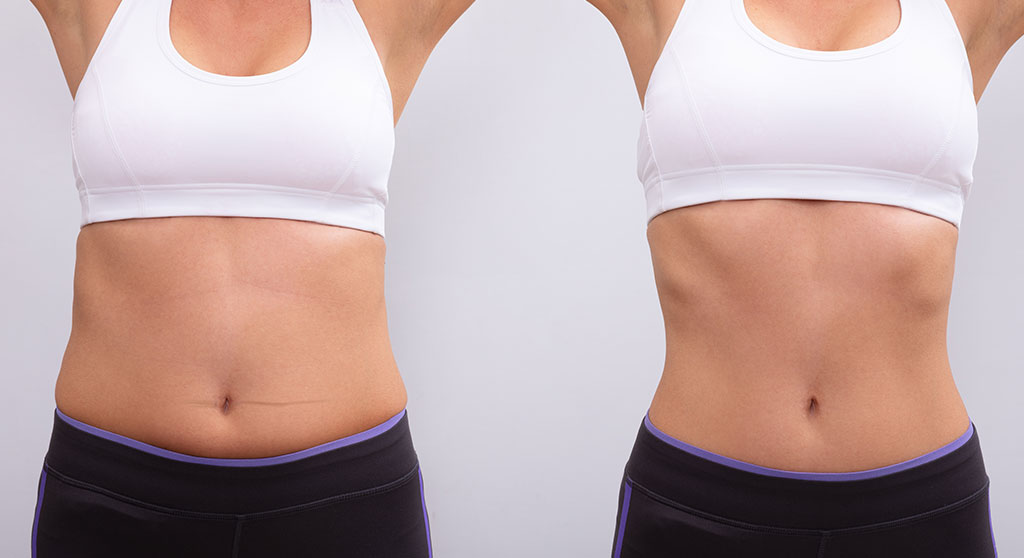 remodelare corporala