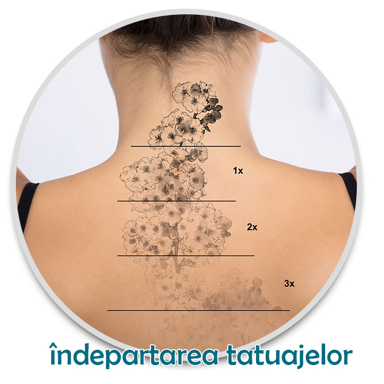 scoatere tatuaje