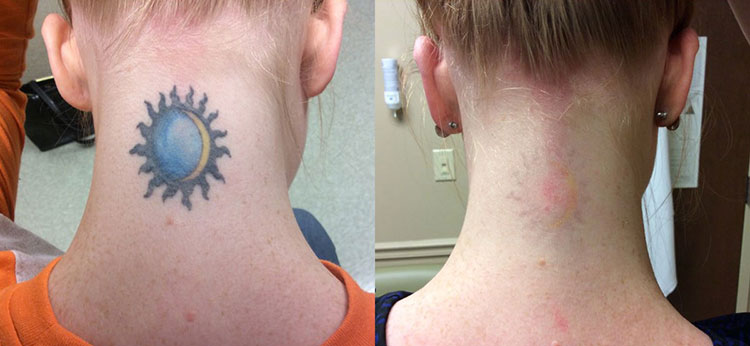 scoatere tatuaje